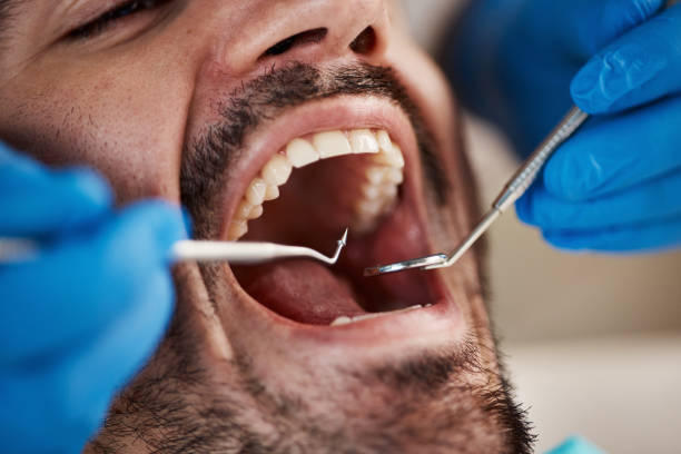 Best Emergency Wisdom Tooth Extraction in Wildwood, TN